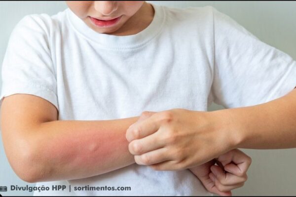 Picada de abelha em crianças : quando se preocupar?
